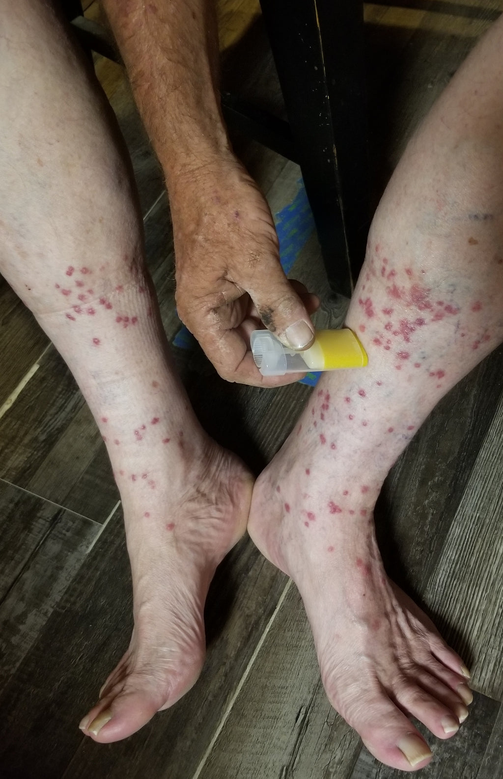 Bug Bite Relief Balm Stick