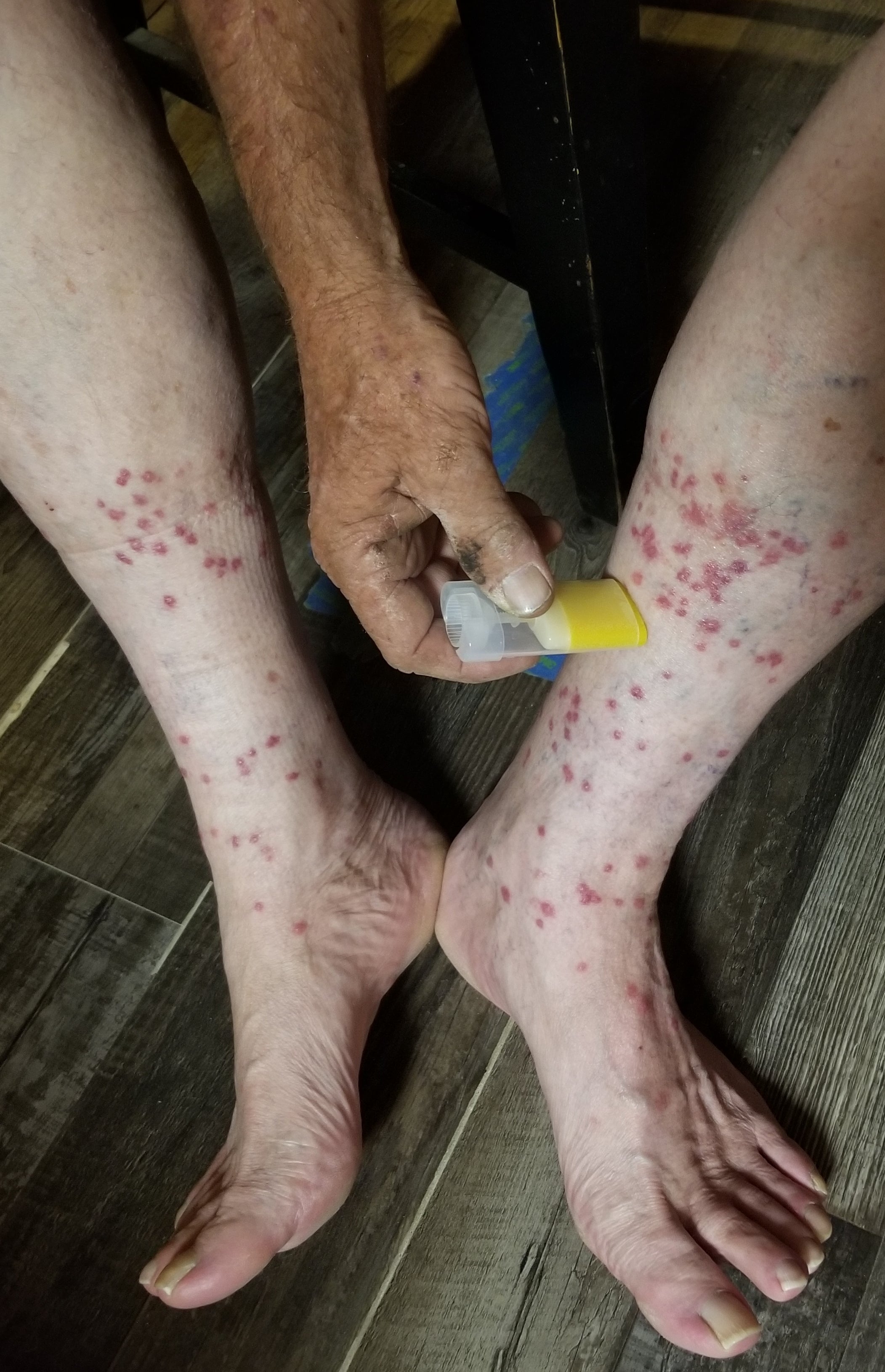 Bug Bite Relief Balm